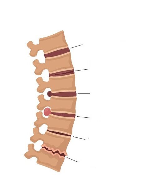 bone changes of the spine