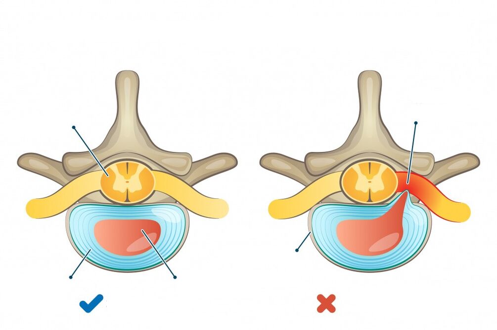 intervertebral discs - one healthy, the other herniated
