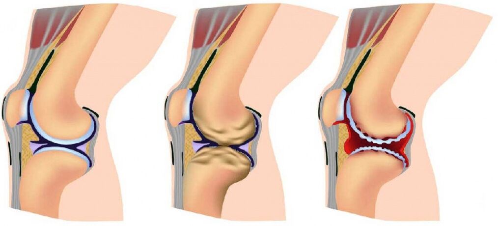 Healthy joint and joint joint
