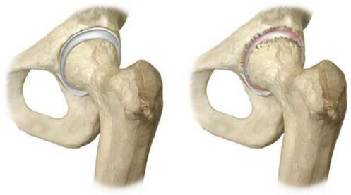 healthy and hip joint affected by arthrosis